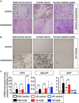 Human Serum Enhances Biomimicry of Engineered Tissue Models of Bone and Cancer